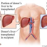 Benefits And Risks: Liver Transplant in Delhi
